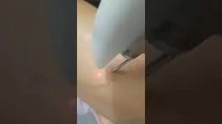 העלמת נימים ברגליים על ידי טכנולוגיית הלייזר מבית fotona  ALOKINO