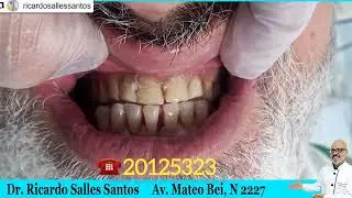 Dentadura tradicional é boa?