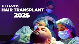 Hair Transplant Turkey 2025