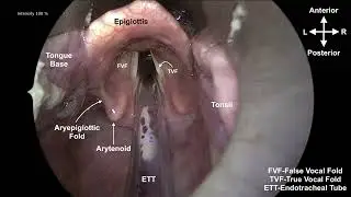 Direct Laryngoscopy with throat biopsy