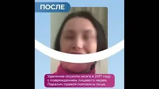 Лицевой нерв. Результат реконструкции