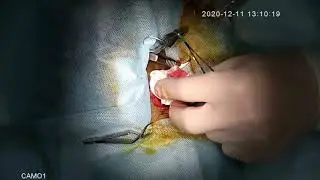 Удаление новообразования подкожного у кошки (Resection of a subcutaneous neoplasm in a cat)