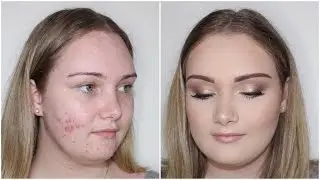 Acne Coverage Client Tutorial ♡ Jasmine Hand