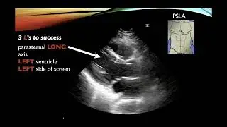 Basic Cardiac Ultrasound Views and Pathology - Echocardiography
