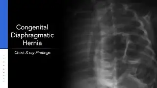 Congenital Diaphragmatic Hernia: Explanation of Chest X-ray Findings