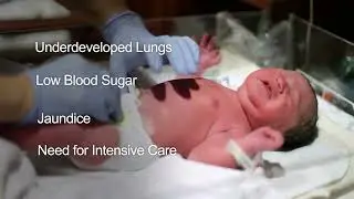 Circumcision for Premature Babies: Key Health Factors & Rabbi Rappaport's Expertise