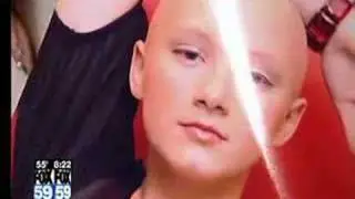 Alopecia kid achieving success