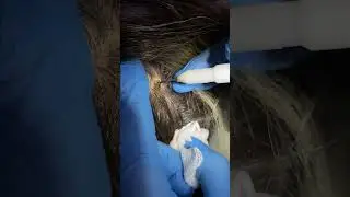 Удаление атеромы на голове