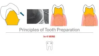 Principles of crown preparation
