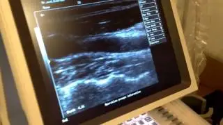 Máy siêu âm xách tay màu Mindray DP 10
