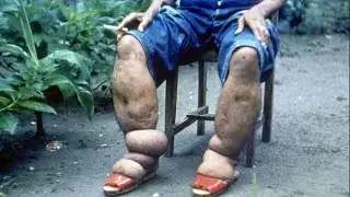 20 Rare Overseas Diseases