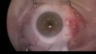 Bulbar Pyogenic Granuloma Removal