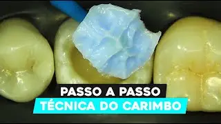 Domine a Técnica do Carimbo em Odontologia: Passo a Passo para Moldagem Precisa!