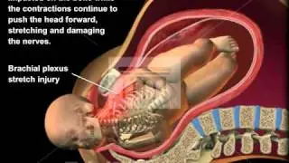 Shoulder Dystocia Medical Animation