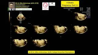 Hamil muda 4 weeks penebalan desidualisasi endometrium.
