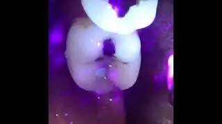 Showing a cracked tooth using transillumination with a curing light