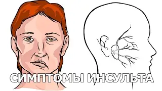 Симптомы и признаки инсульта