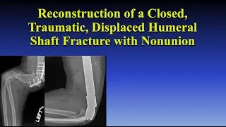 Reconstruction of a Closed, Traumatic, Displaced Humeral Shaft Fracture with Nonunions