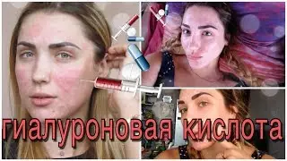 ВСЕ О ГИАЛУРОНОВОЙ КИСЛОТЕ / ГИАЛУРОНОВАЯ КИСЛОТА ПРОТИВ ШРАМОВ