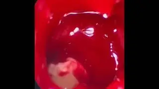 Лечение одонтогенного гайморита