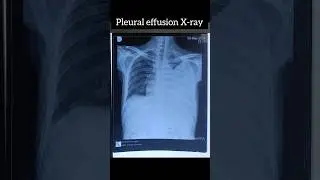 Chest Xray of Pleural Effusion