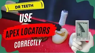 Contraindications of Using Apex Locators