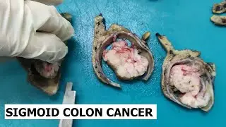 Colon cancer grossing #4 - Sigmoid colon cancer