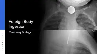 Foreign Body Ingestion Chest Xray