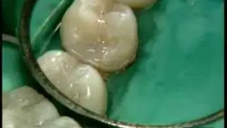 Restauración de Posteriores Dr. P.Colon - Quixfil /2