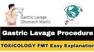 Gastric Lavage | Stomach Wash | Toxicology (FMT) | Easy Explaination