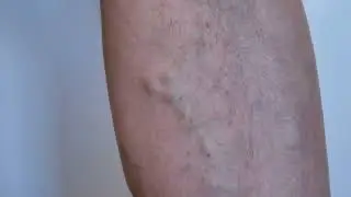 Deep Vein Thrombosis (DVT)