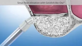 Sinus Lift Surgery For Dental Implants at ORA