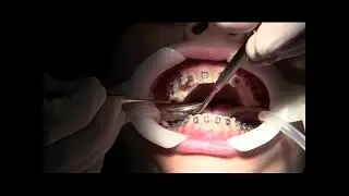 Orthodontic bracket placement