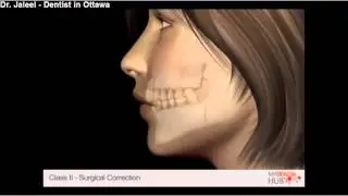 Oral Surgery - Class II Surgical Correction - Ottawa Dentist