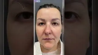 Вeрхняя блефароплаcтика
