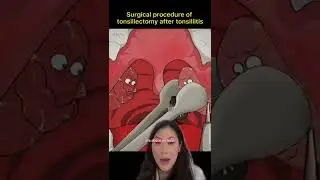 Tonsillectomy Procedure Cartoon (fast & easy) 