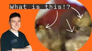 We find FUNGAL SPORES in an Ear Canal! - Ear Wax Removal Ep.11