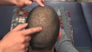 ASMR - Head & Scalp Gentle Tapping and Tickle Massage - Very Relaxing