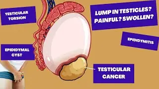 I've found A Lump In My Testicle, Could It Be TESTICULAR CANCER? | Causes of Testicular Pain/Lumps
