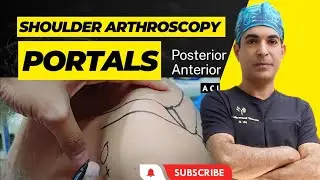 Shoulder arthroscopy portals | Primary portals