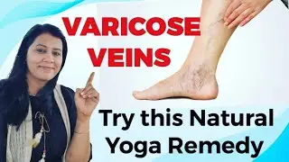 How to get rid of VARICOSE VEINS Naturally - Try this natural yogic remedy and get rid of pain legs