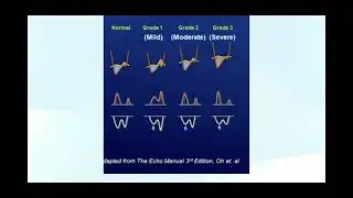 Measuring and Grading Diastolic Dysfunction using Echocardiography - Diastology!