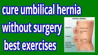 how to cure umbilical hernia without surgery | best exercises for umbilical hernia