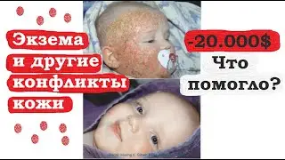 Кожные заболевания - какие конфликты? | Экзема - 20.000$ не помогли, что помогло?