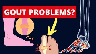 Suffering from gout? Start avoiding these foods now!