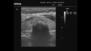 Ultrasound video - Thyroid gland size determination: complete freehand technique