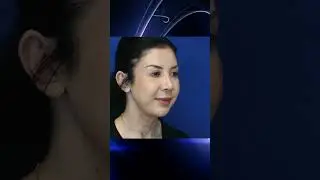 Correction of the Drooping Nasal Tip! | Balanced Rhinoplasty! | Before+After