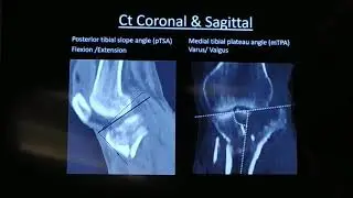 Tibial plateau 3 column theory