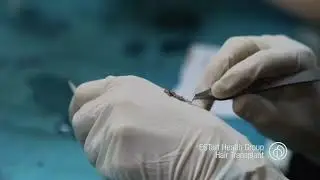 ESTart Health Group Hair Transplant
