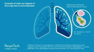 Example of what can happen in the lungs due to bronchiectasis